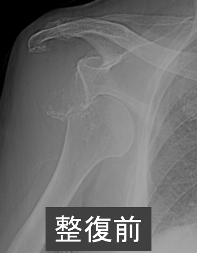 肩関節脱臼（習慣性肩関節脱臼・反復性肩関節脱臼） | 芦澤整形外科